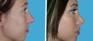 هزینه جراحی بینی در آمل 1405