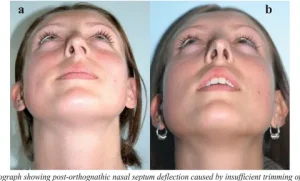 هزینه جراحی بینی در آمل