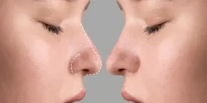 هزینه جراحی بینی در آمل