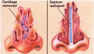 هزینه جراحی بینی در آمل