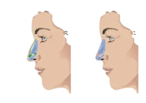 قیمت عمل بینی در آمل - ارزان‌ترین