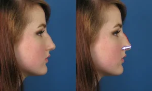 قیمت عمل بینی در آمل - ارزان‌ترین